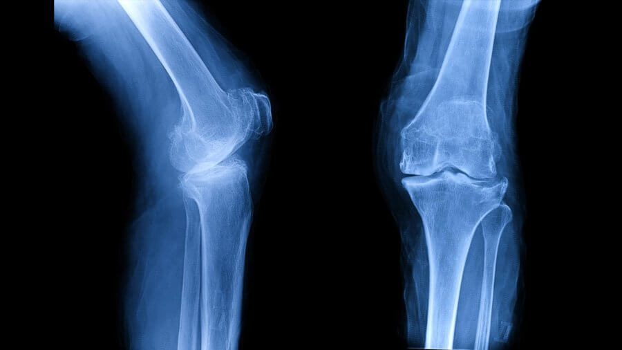 osteoarthritis-oa-knee-film-xray_shutterstock_756734566-900x506-1.jpg
