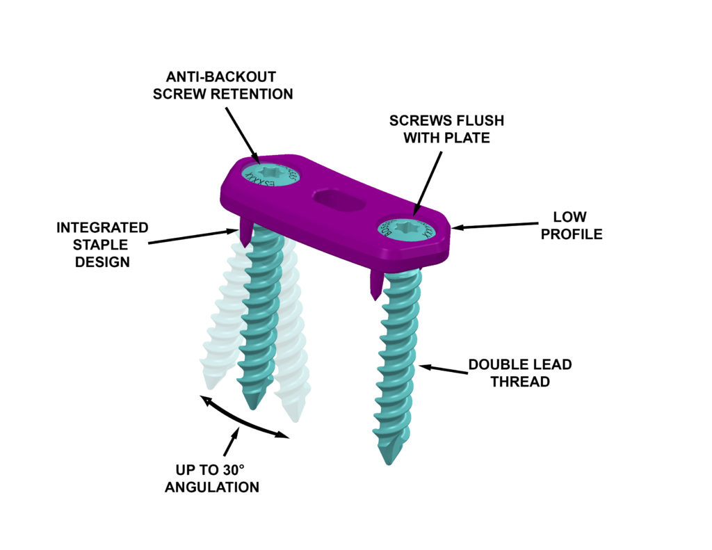 Plate-and-Screws-Features-1024x791.jpg