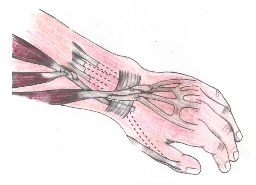 Tendon-Transfers_0.jpg