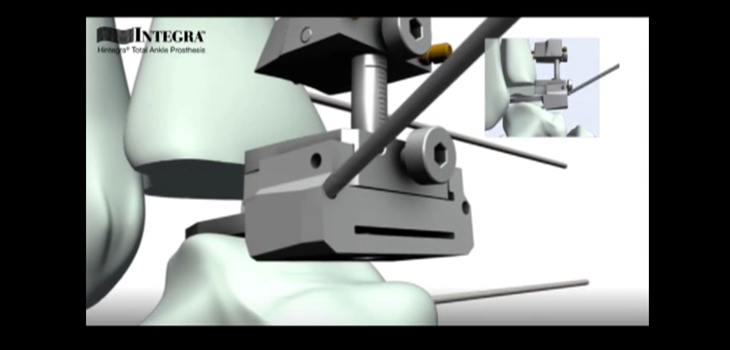 Integra_CadenceTotalAnkleSystem_WEB.jpg