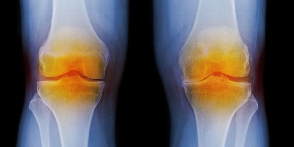 landscape-1446728472-g-osteoarthritis-103772368-1.jpg