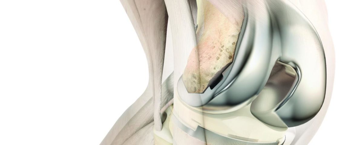 ATTUNE-Knee-on-Bone-Option-2-1-1200x480.jpg
