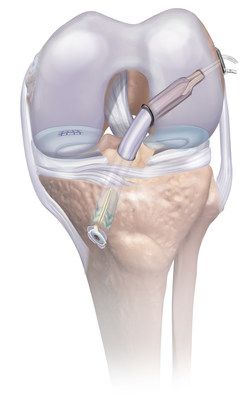 Mitek_Sports_Medicine_Introduces_Comprehensive-4f951d673a40a9e48269bfd4e105c577-1.jpg