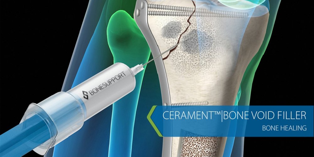 cerament-bone-healing-17897b-h900-1-1.jpg