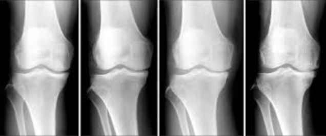 knee-deformity1-1.jpg