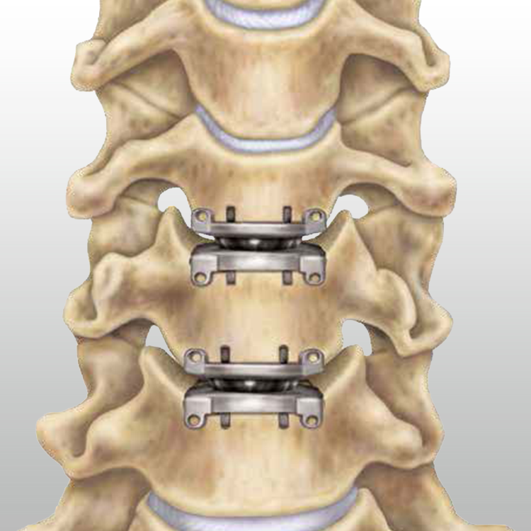 neck-surgery-750x750-1.png