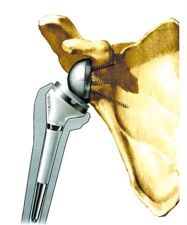 reverse-sholder-replacement.jpg