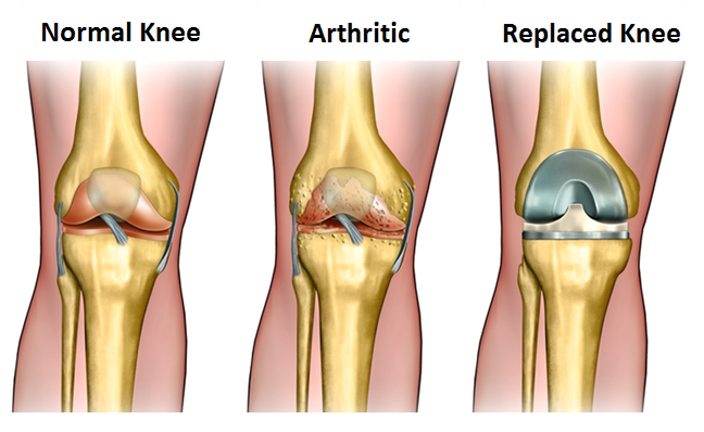 total-knee-replacement-medifee-1.png