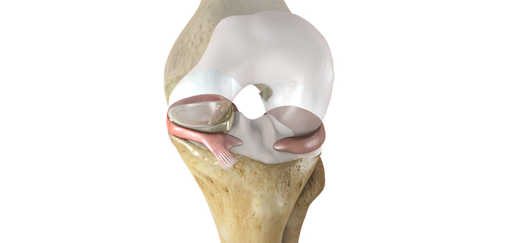 Meniscus_NusurfaceMeniscusImplant_WEB-1.jpg