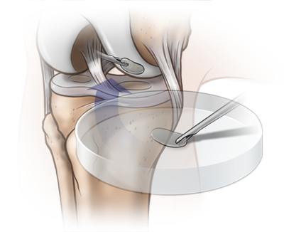 knee_illustration_04-1.png