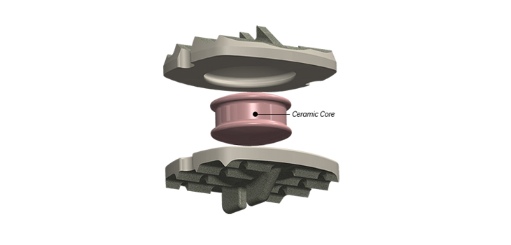 Simplify_SimplifyCervicalArtificialDisc_WEB-1.jpeg