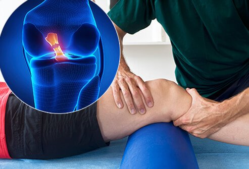 sports-injuries-s3-torn-acl-1.jpg