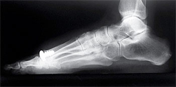 Arthrosurface-350-1.jpg