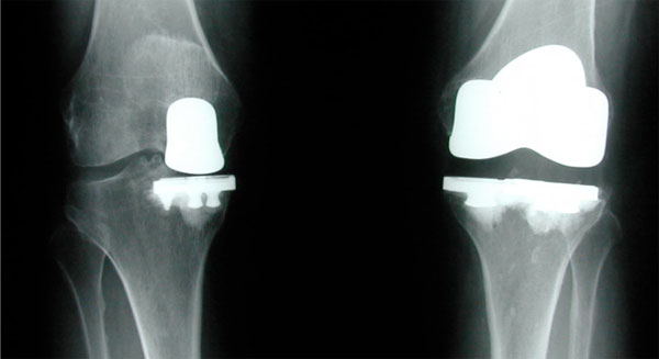 partialvstotalkneereplacement2-1.jpg
