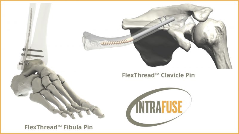 171101-Press-Release-IntraFuse-Graphic-1-e1510689010327.jpg