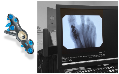 In2Bones_CoLink_View_ORx-ray-1.jpg