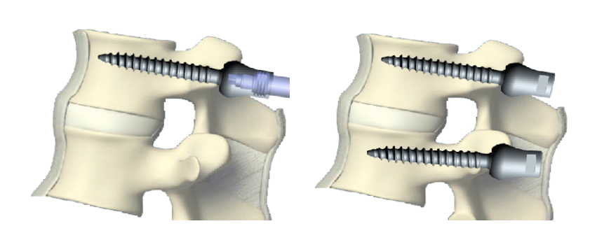 screw-insertion-2.png
