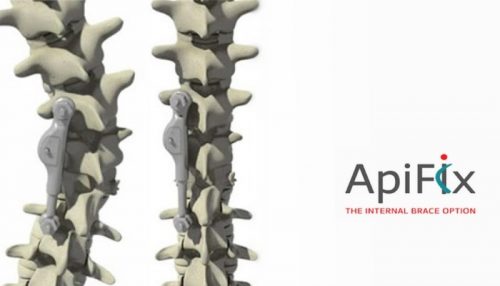 apifix-7x4-e1514914478997-3.jpg