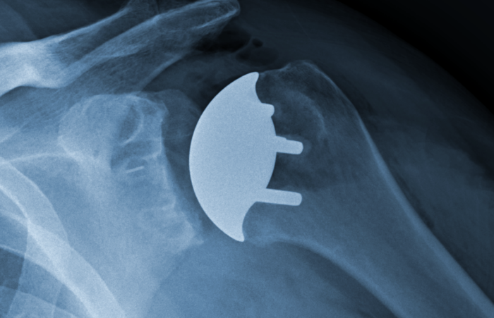 xray_crop-700x451.png