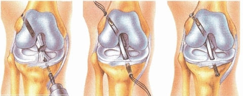 Figure_2_-_Example_of_ACL_reconstruction_using_CelGro®_collagen_rope-1.jpg