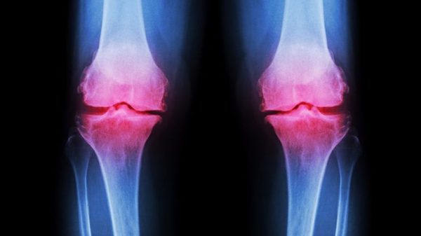 1009_Arthritis_env-1-e1522250939581.jpg