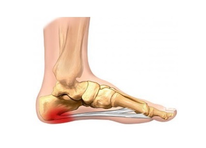 plantar_fasciitis-A-1.jpg