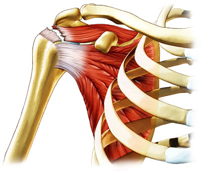 rotator_cuff_tear-1-1.jpg