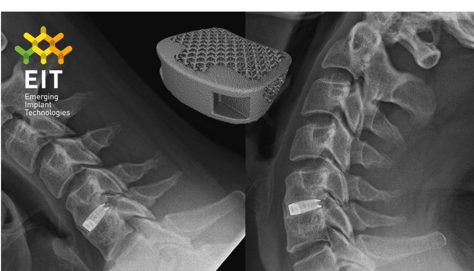 PR-Xray-w-CIF-implant-1-1.png