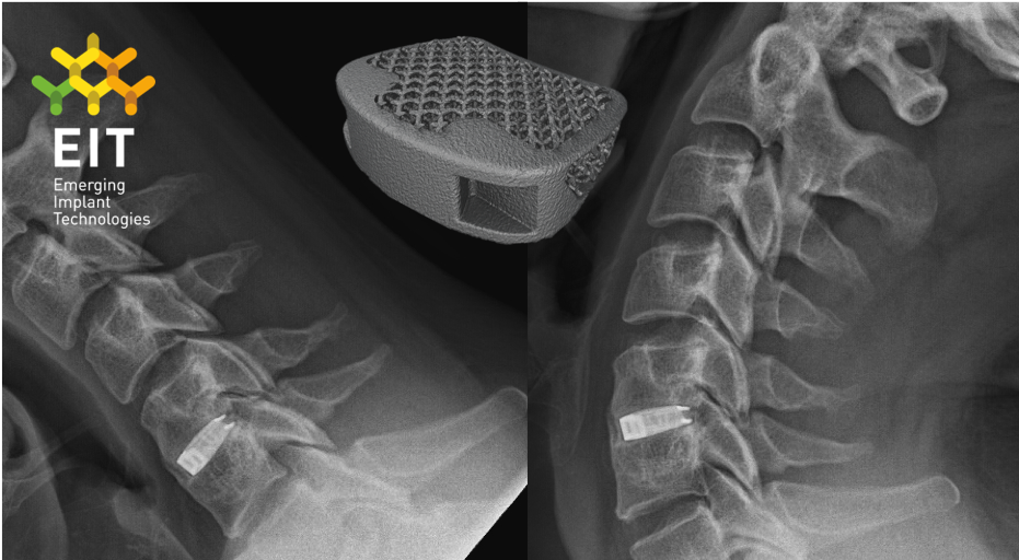 PR-Xray-w-CIF-implant.png