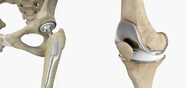 hip-and-knee-replacement-12bto-2.jpg