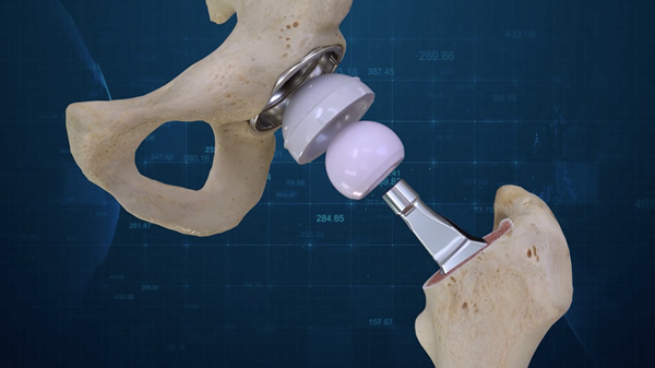 Conformis-Hip-System-Image-1.png