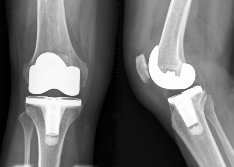 total-knee-replacement-123663788-5b01c724642dca0037c139a9-1.jpg