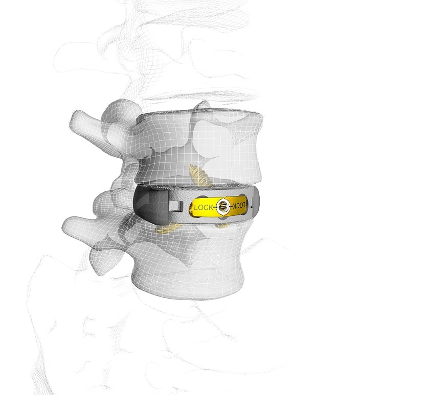 1_M3_Implanted-12bto2-1.jpg