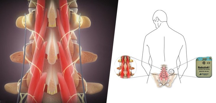 Device_MainstayMedicalReActiv8_WEB-1.jpg
